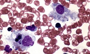 Familial Hemophagocytic lymphohistiocytosis, 3 वर्ष के मरीज़ के जीन में दुर्लभ म्यूटेशन
